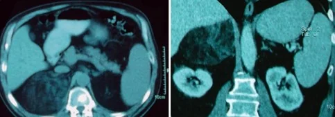 ADRENAL MYELOLIPOMA