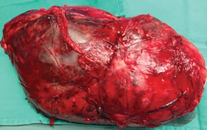 ADRENAL MYELOLIPOMA
