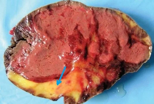 ADRENAL MYELOLIPOMA