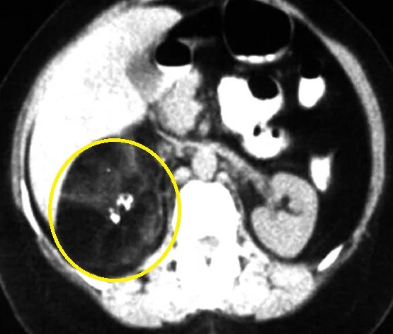 ADRENAL MYELOLIPOMA