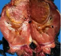 ADRENAL NEUROBLASTOMA