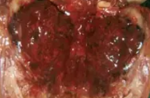 ADRENAL NEUROBLASTOMA 