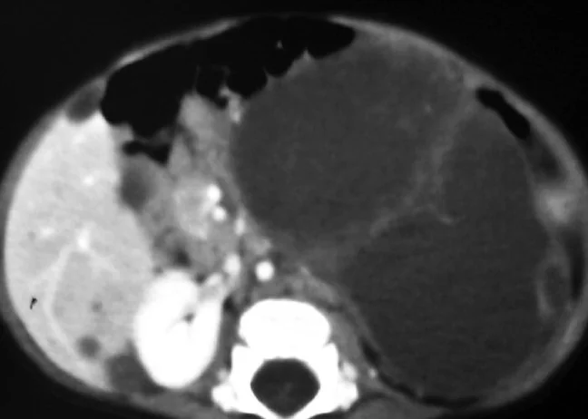 ADRENAL NEUROBLASTOMA