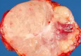 ADRENAL NEUROBLASTOMA 