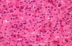 ADRENAL ONCOCYTOMA