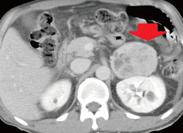 ADRENAL PHEOCHROMOCYTOMA