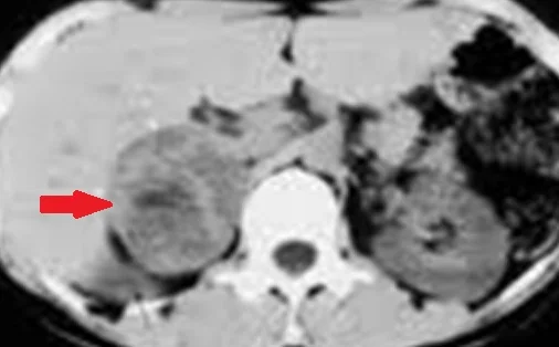 ADRENAL PHEOCHROMOCYTOMA