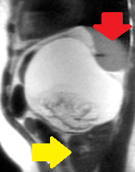 ADRENAL TERATOMA