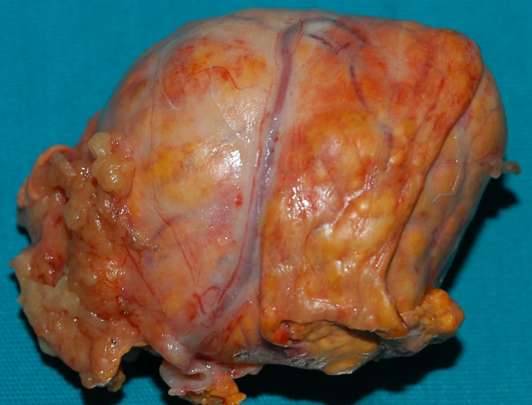 ADRENAL PHEOCHROMOCYTOMA