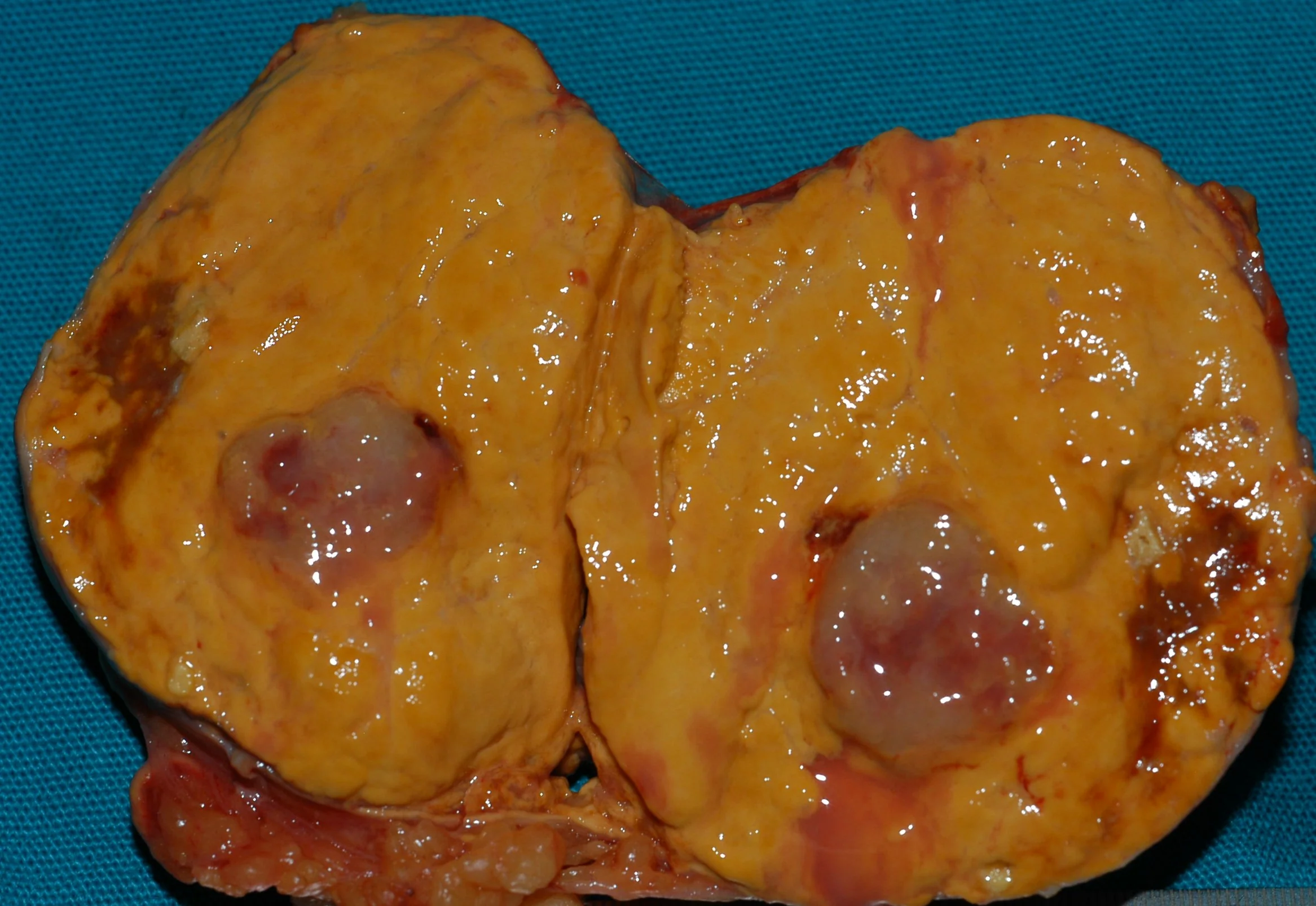 ADRENAL PHEOCHROMOCYTOMA