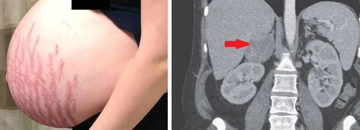 ADRENOCORTICAL ADENOMA