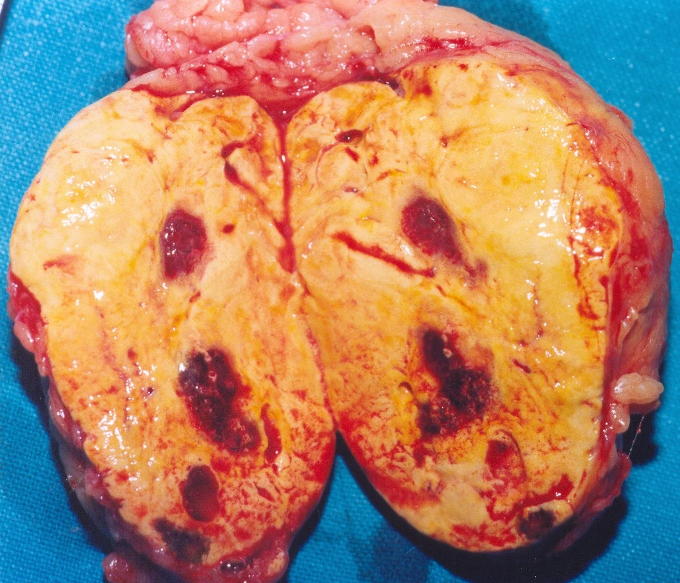 ADRENOCORTICAL ADENOMA