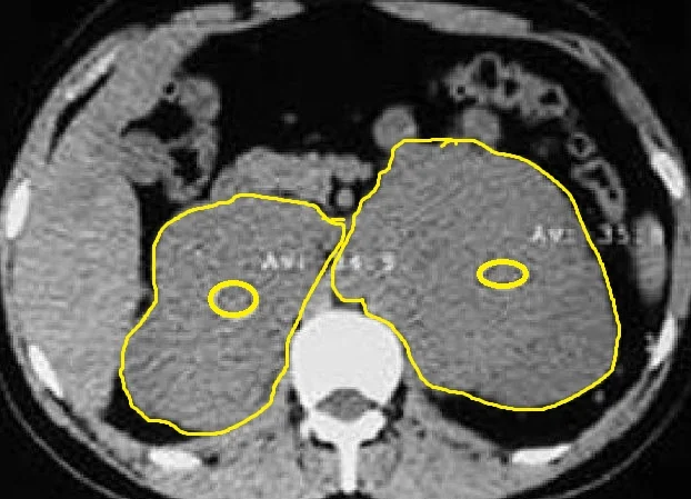 BILATERAL ADRENAL INCIDENTALOMAS