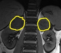 BILATERAL ADRENAL TUMORS