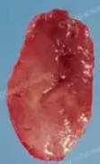 CAROTID BODY TUMOR