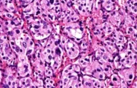 CAROTID BODY TUMOR
