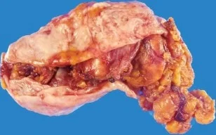CYSTIC ADRENAL LESION