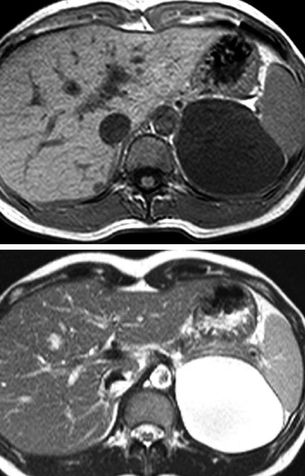 CYSTIC ADRENAL LESION