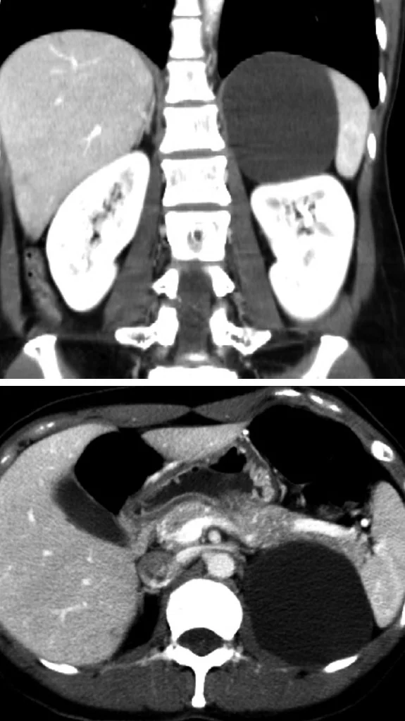 CYSTIC ADRENAL LESION