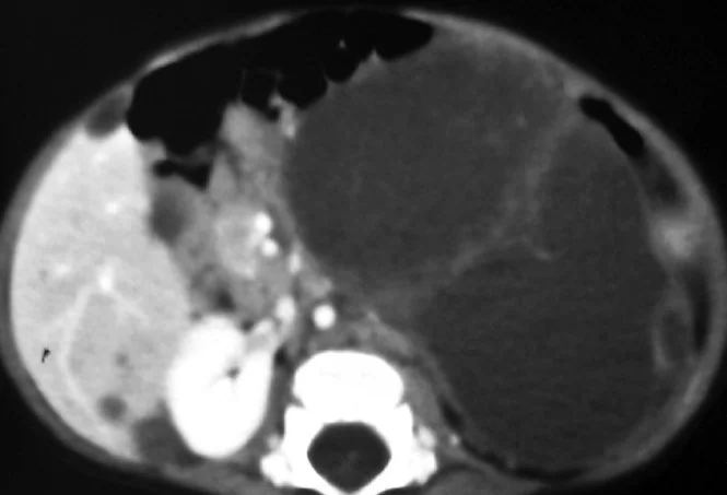 CYSTIC ADRENAL LESION
