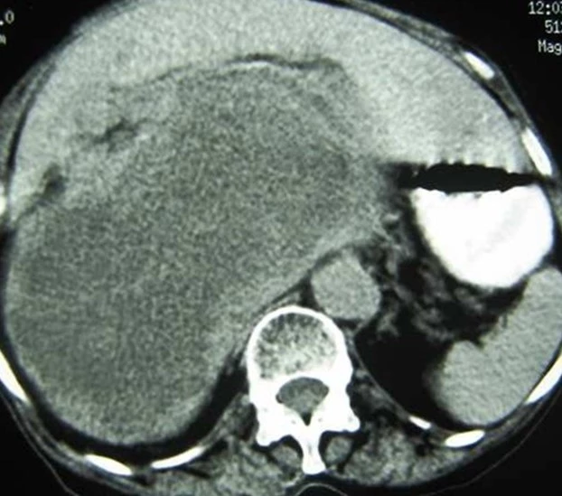 CYSTIC MALIGNANT PHEOCHROMOCYTOMA
