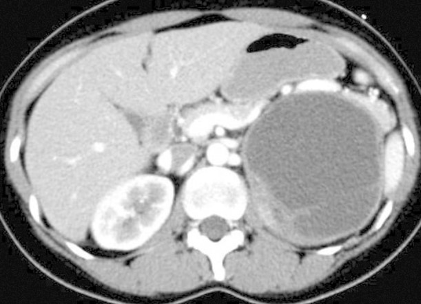 CYSTIC PHEOCHROMOCYTOMA