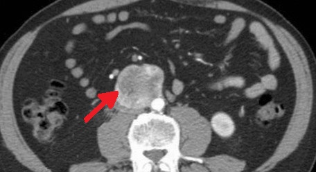 PARAGANGLIOMA