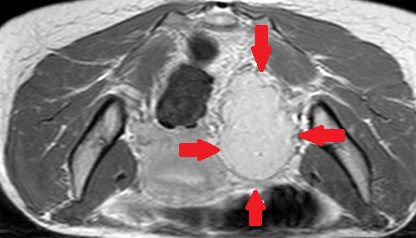 SYMPATHETIC PARAGANGLIOMA