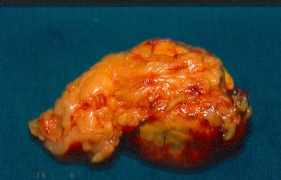ADRENAL PHEOCHROMOCYTOMA