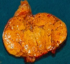 ADRENAL PHEOCHROMOCYTOMA