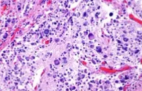 GAGLIONEUROBLASTOMA