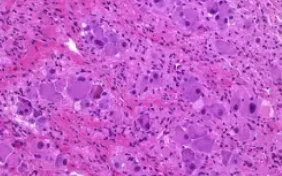 GANGLIONEUROBLASTOMA