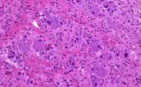 GANGLIONEUROMA