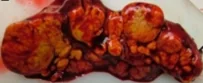 ADRENAL INCIDENTALOMA