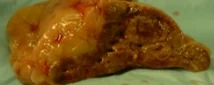 ADRENAL INCIDENTALOMA