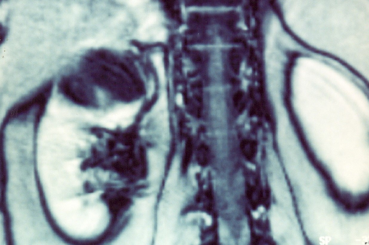 PRIMARY ADRENAL LEIOMYOSARCOMA