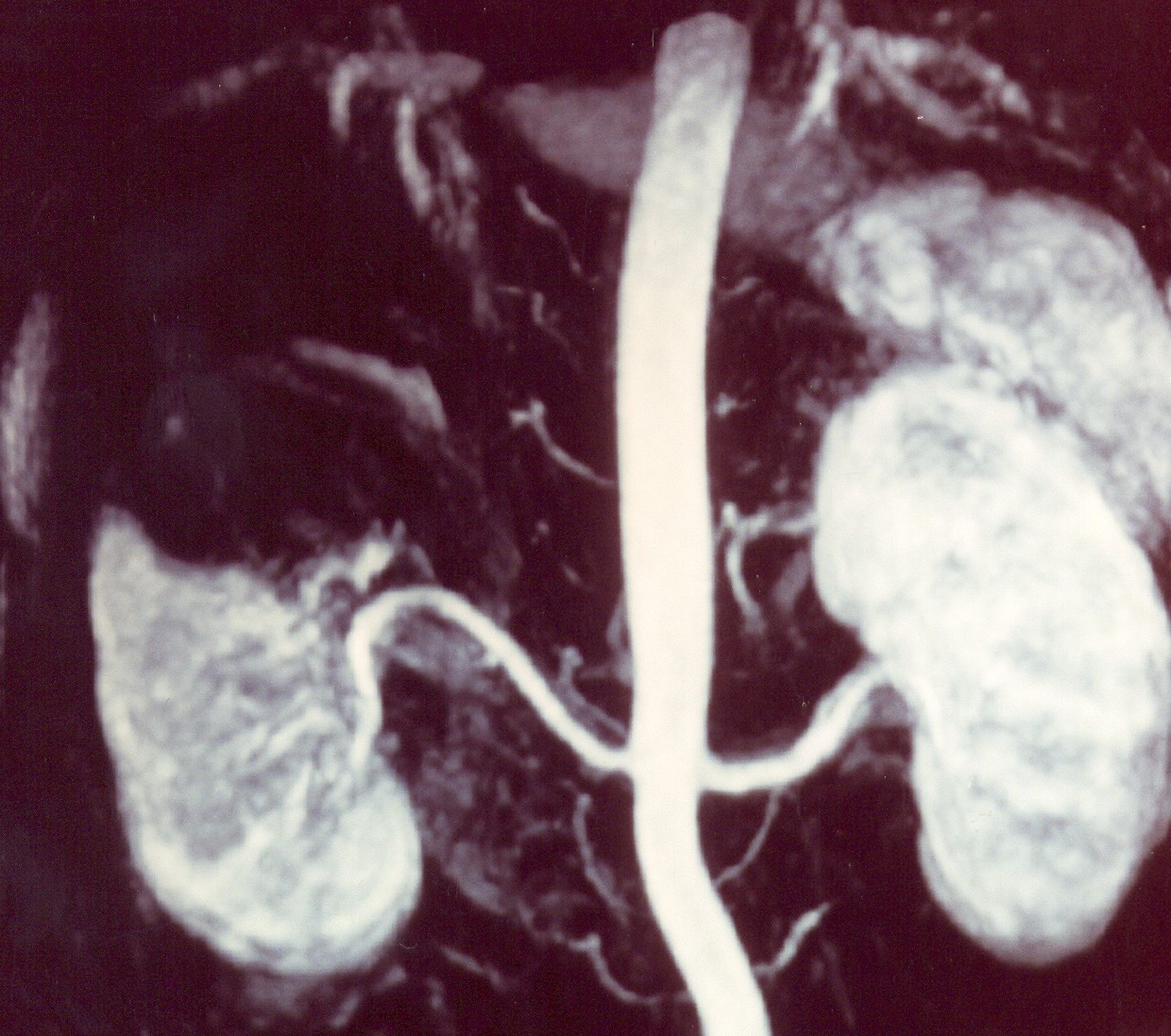 PRIMARY ADRENAL LEIOMYOSARCOMA