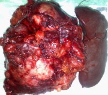 MALIGNANT ABDOMINAL PARAGAGLIOMA