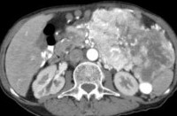 MALIGNANT ABDOMINAL PARAGAGLIOMA
