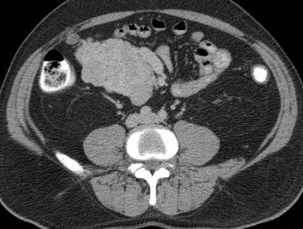 MALIGNANT PARAGANGLIOMA - MESENTERY