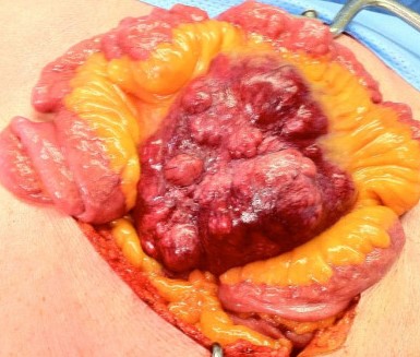 MALIGNANT PARAGANGLIOMA - MESENTERY