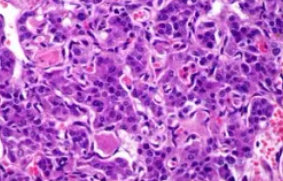MALIGNANT PHEOCHROMOCYTOMA