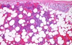 ADRENAL MYELOLIPOMA