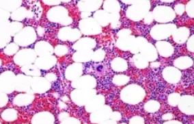 ADRENAL MYELOLIPOMA