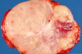 NEUROBLASTOMA
