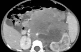 NEUROBLASTOMA