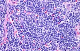 NEUROBLASTOMA