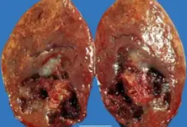 PHEOCHROMOCYTOMA1