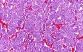 PHEOCHROMOCYTOMA