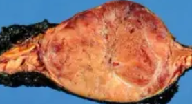 PHEOCHROMOCYTOMA 